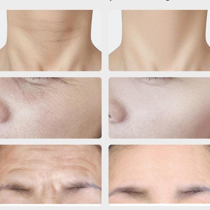 Aparelho Antirrugas Lifting Facial - Nannyvarie